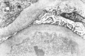  F,31y. | initial glomerular hyalinosis and sclerosis